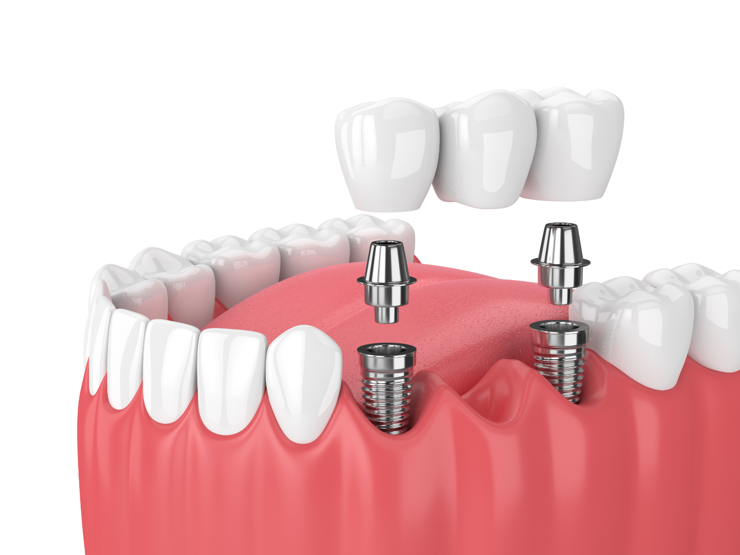 Dentist Supports